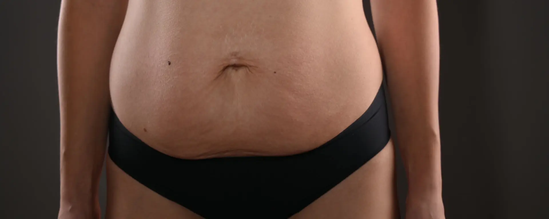 woman's belly Diastasis Recti before and after diastasis recti exercises to heal